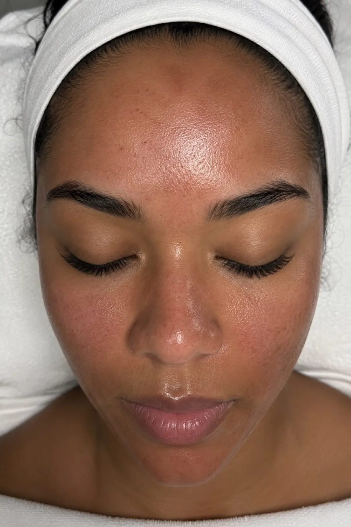 A client's healthy, glowing skin after a facial at The Skin Studio Chelsfield