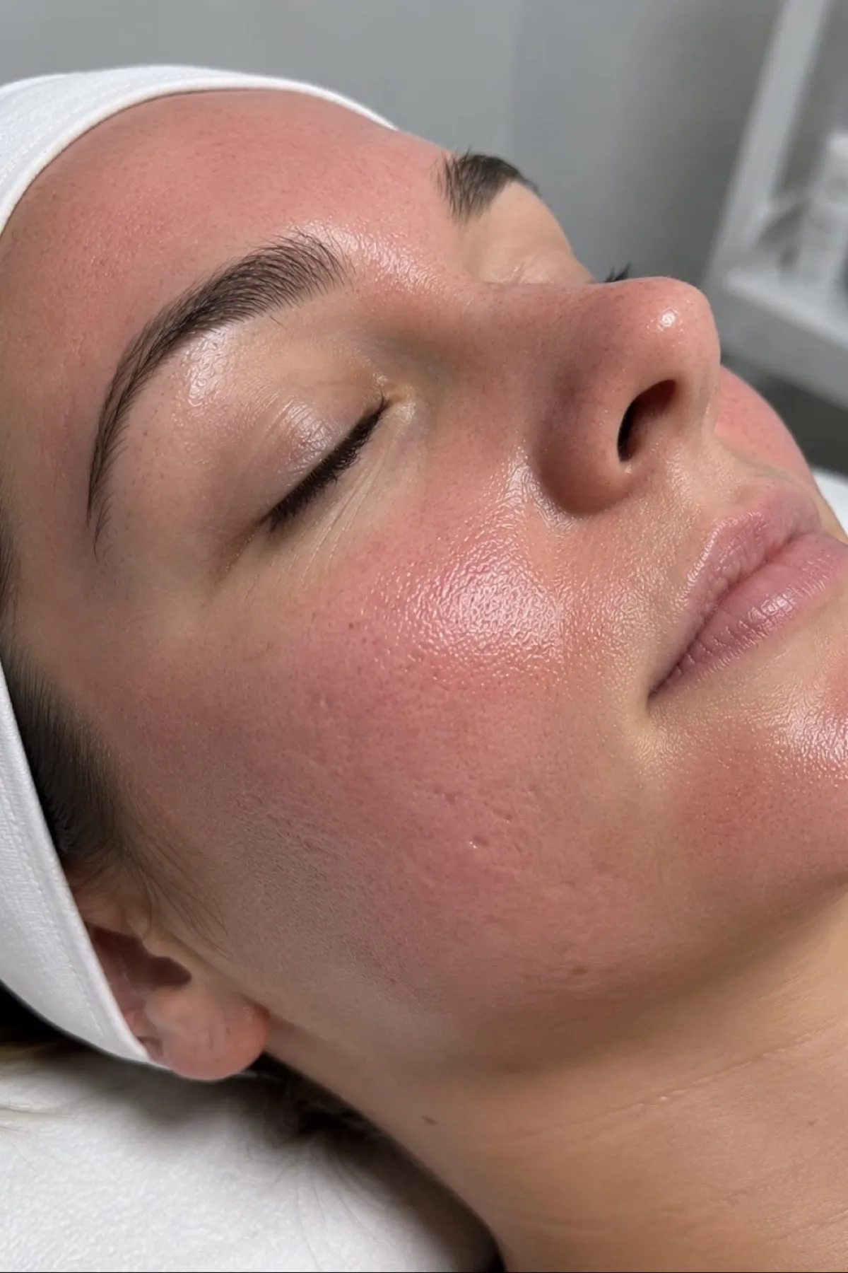 Healthy, glowing skin after the Peptide Lift and Glow Facial at The Skin Studio Chelsfield
